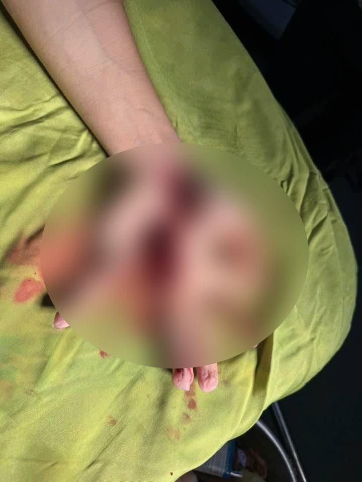 Tiktoker bị chém gần đứt lìa bàn tay giữa phố Thái Nguyên: Bác sĩ thông tin về ca mổ kéo dài đến 1h sáng- Ảnh 2.