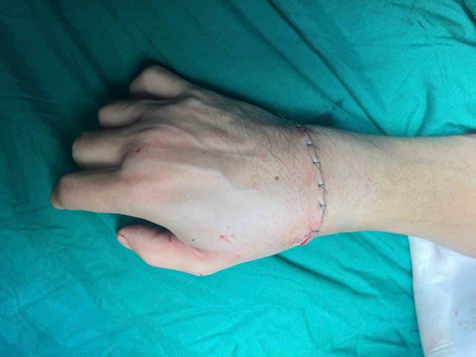 Tiktoker bị chém gần đứt lìa bàn tay giữa phố Thái Nguyên: Bác sĩ thông tin về ca mổ kéo dài đến 1h sáng- Ảnh 1.