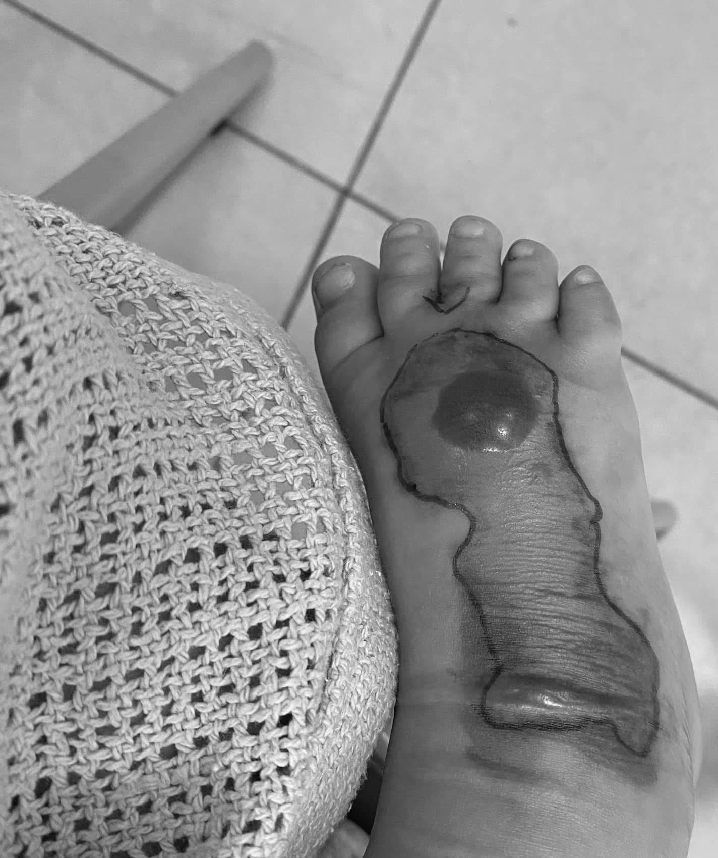 Chỉ một vết mèo cào tưởng vô hại, em bé phải cắt bỏ một phần chân khiến phụ huynh sợ hãi