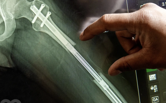 Đàn ông Mỹ ám ảnh chiều cao, đổ xô đi phẫu thuật kéo dài chân- Ảnh 9.