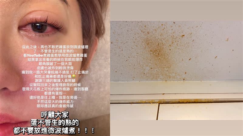 1 nữ diễn viên bị thủng giác mạc vì bỏ trứng vào lò vi sóng- Ảnh 2.