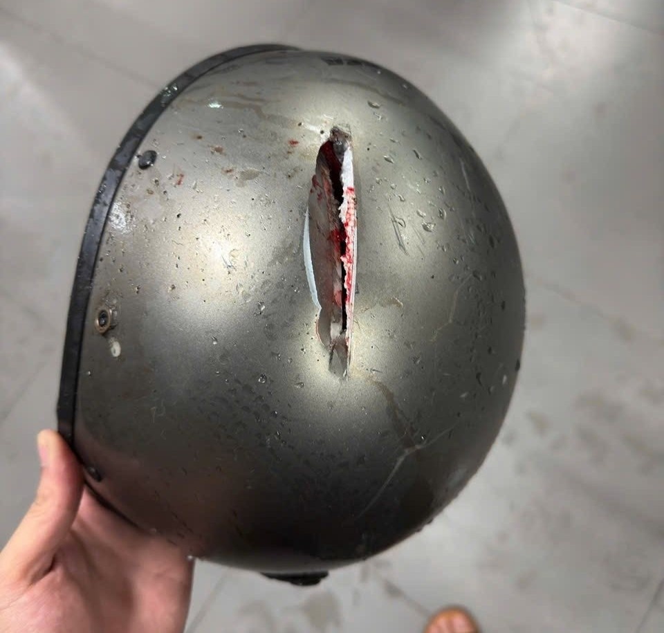 Chàng trai Hà Nội bị mảnh kính đâm xuyên mũ bảo hiểm giữa cơn dông gây vỡ xương sọ- Ảnh 1.