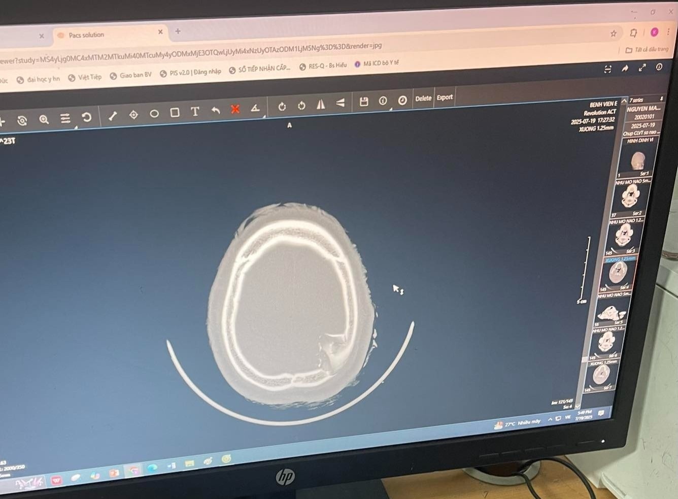 Chàng trai Hà Nội bị mảnh kính đâm xuyên mũ bảo hiểm giữa cơn dông gây vỡ xương sọ- Ảnh 2.