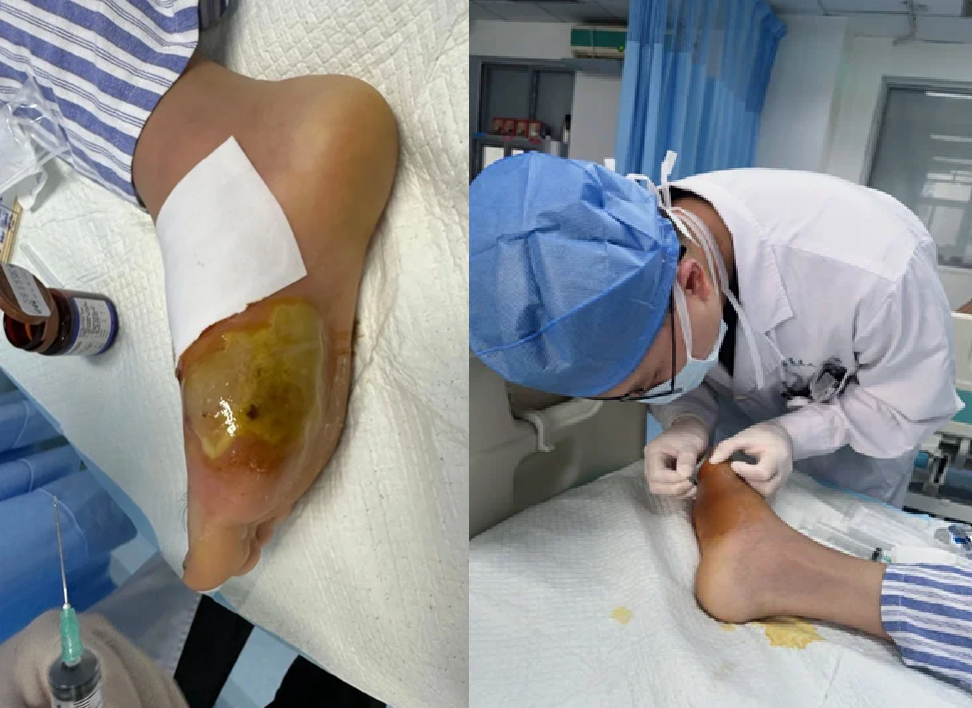 Suýt mất cả bàn chân vì giẫm phải cây tăm- Ảnh 1.