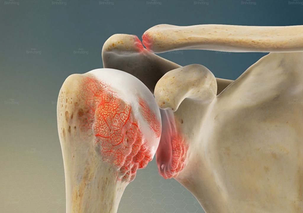 Từng tự hào chốt trăm đơn mỗi ngày, giờ tôi phải gác lại tất cả vì thoái hóa đốt sống cổ...- Ảnh 3.