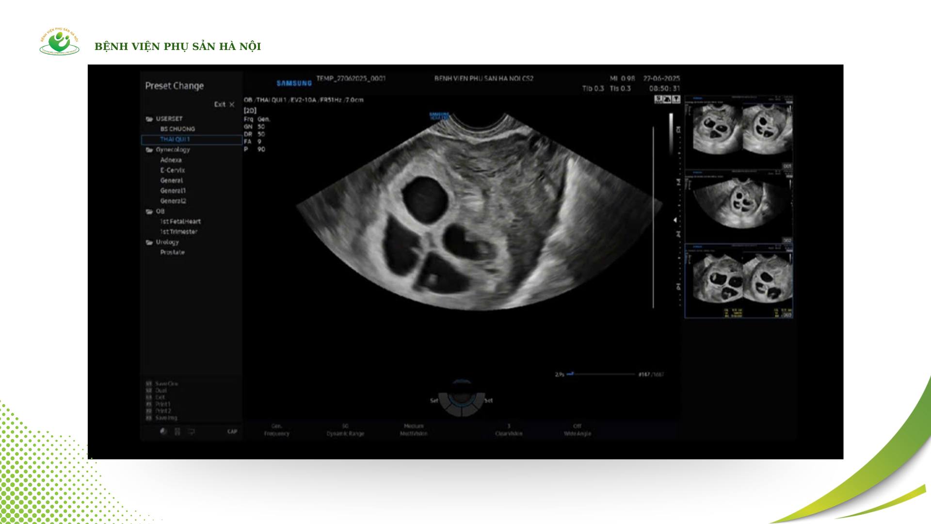 Cực hiếm gặp: Bệnh viện Phụ Sản Hà Nội ghi nhận 1 sản phụ mang thai 4 tự nhiên, tỷ lệ chỉ khoảng 1/700.000 - 800.000 ca- Ảnh 1.