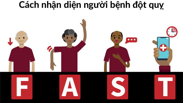 Ngày càng nhiều người trẻ bị đột quỵ: Cảnh báo những dấu hiệu đột quỵ khi ngủ, người khỏe mạnh cũng không được chủ quan