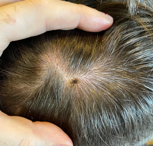 KIỂM TRA NGAY: Nốt ruồi mọc ở 6 vị trí này trên cơ thể rất dễ biến hình thành ung thư!