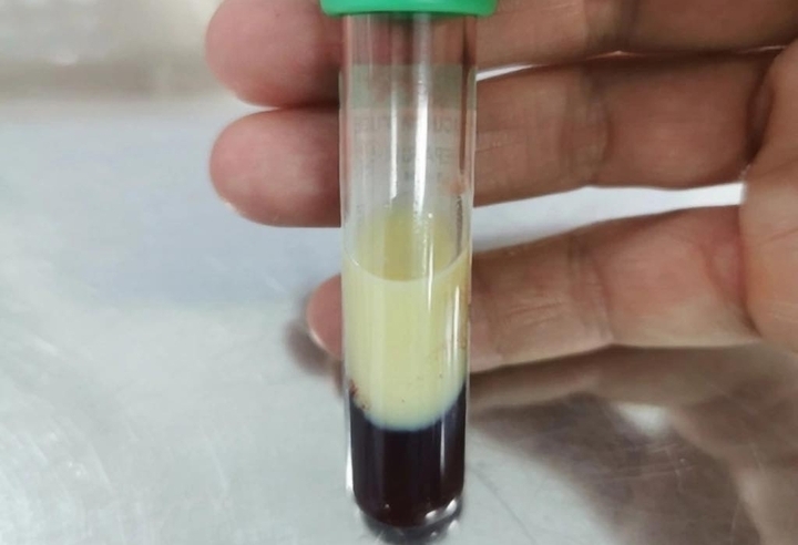 Uống bia để dễ ngủ, lập trình viên sốc khi mỡ máu cao gấp đôi mức báo động