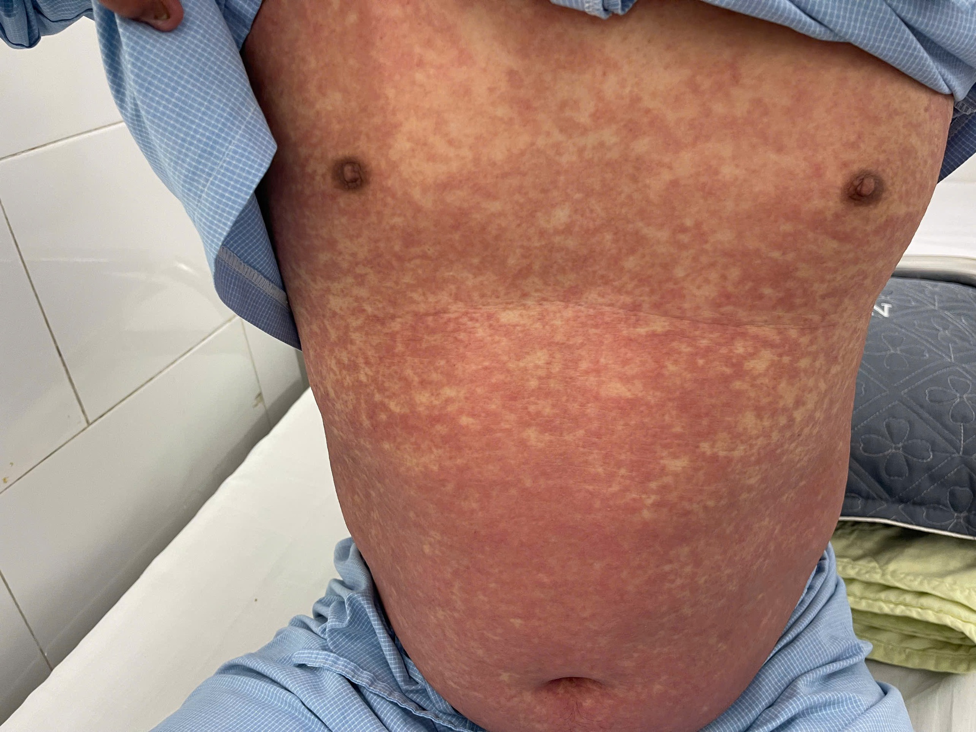 1 người chết, 3 người nguy kịch vì thuốc cấm: Bệnh viện Bạch Mai kêu gọi khẩn- Ảnh 2.