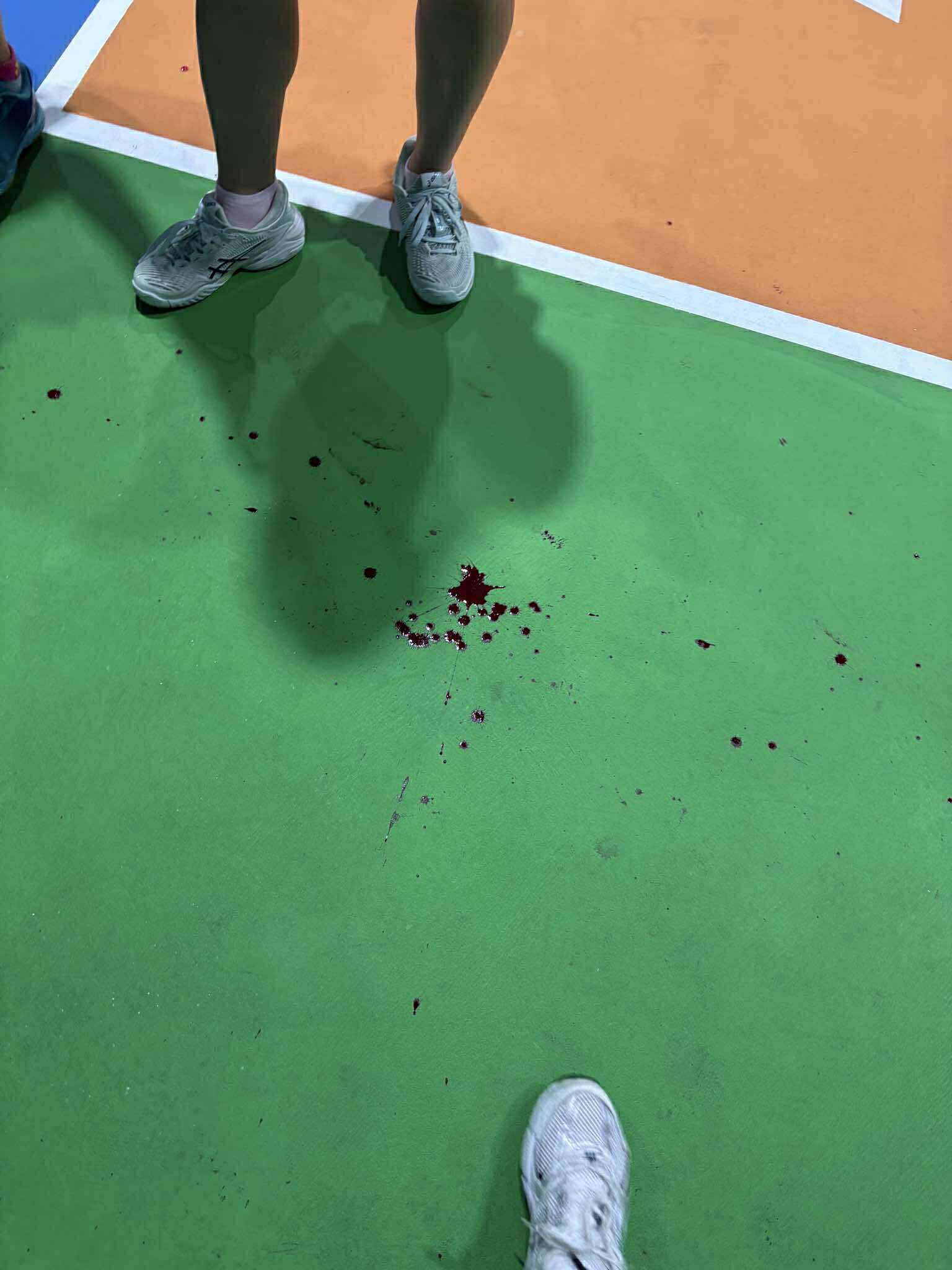 Xôn xao vụ cô gái bị ném vợt vào mặt trên sân pickleball, phải nhập viện cấp cứu- Ảnh 4.