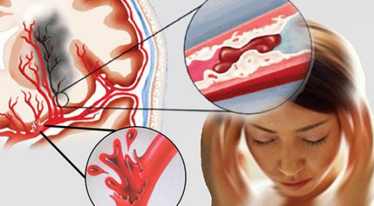 Nữ MC đột ngột qua đời ở tuổi 27: Cảnh báo thói quen sống âm thầm "châm ngòi" cho căn bệnh này ở người trẻ - Ảnh 3.
