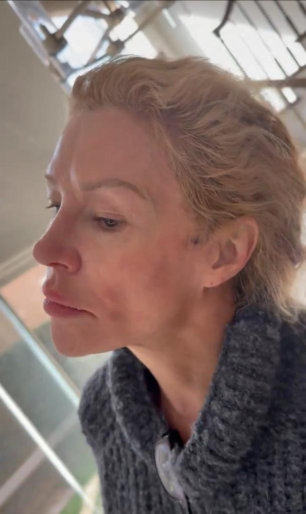 Nữ diễn viên mặt bị "ăn mòn" từng mảng, biến dạng nghiêm trọng vì lí do gì?- Ảnh 6.