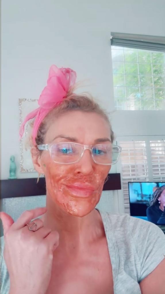 Nữ diễn viên mặt bị "ăn mòn" từng mảng, biến dạng nghiêm trọng vì lí do gì?- Ảnh 3.