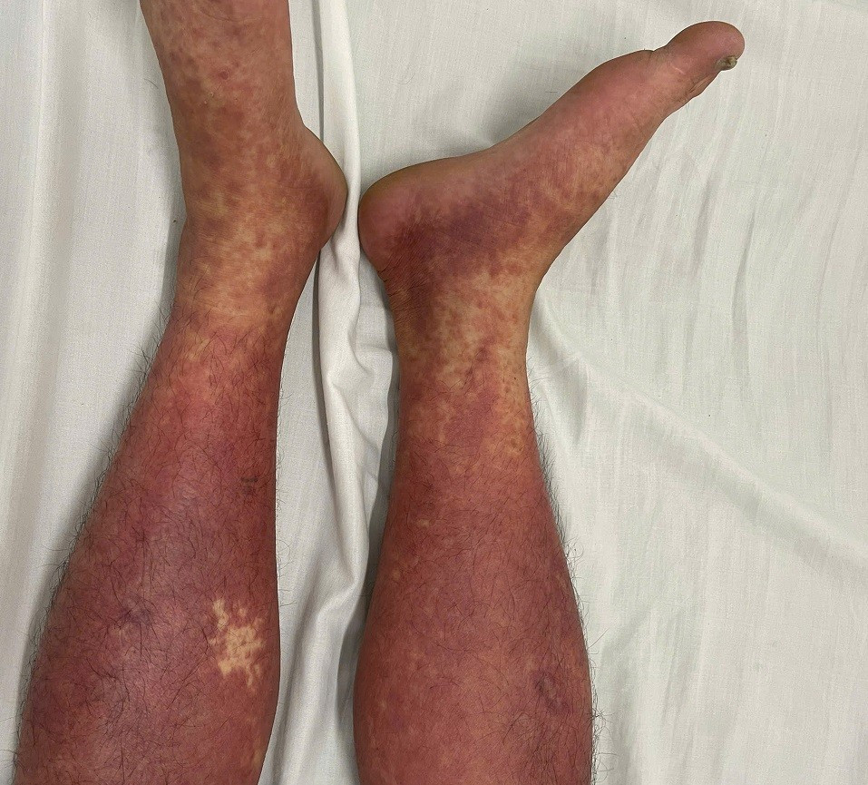 Bộ Y tế cảnh báo: Thuốc cấm Phenylbutazone vẫn bán tràn lan trên mạng gây nhiều ca ngộ độc và tử vong- Ảnh 2.