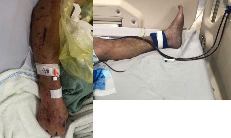 Người đàn ông ở Hưng Yên nguy kịch, tím toàn thân sau chế biến thịt lợn sống, bác sĩ khuyến cáo 3 không- Ảnh 1. Người đàn ông ở Hưng Yên nguy kịch, tím toàn thân sau chế biến thịt lợn sống, bác sĩ khuyến cáo 3 không- Ảnh 1.