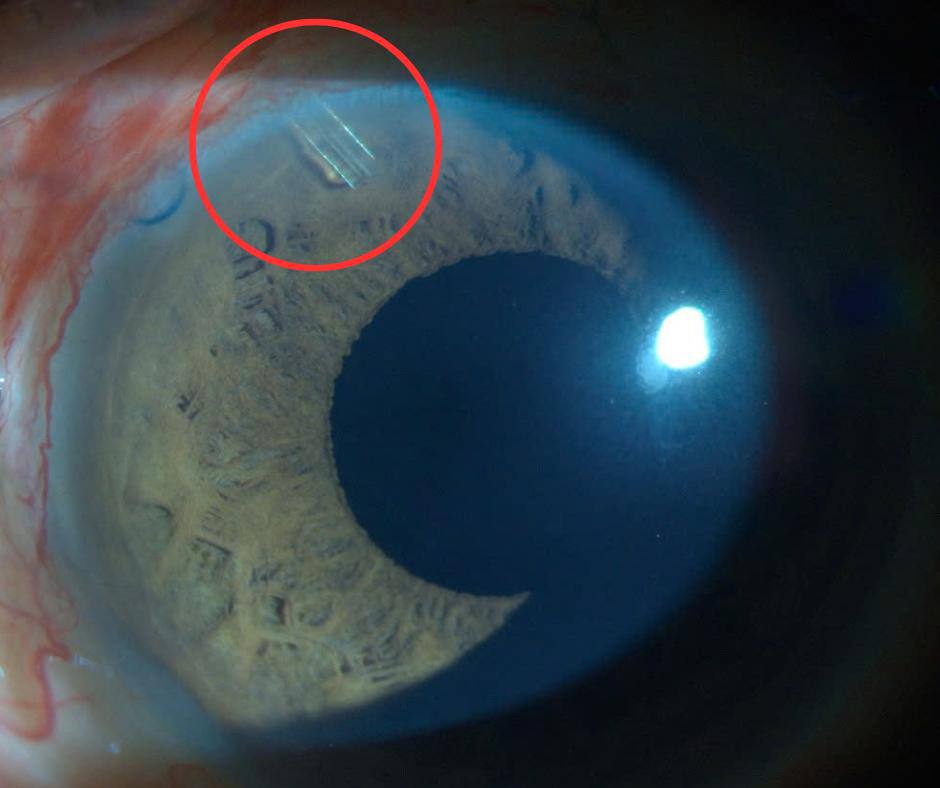 Tin vui: 3 bệnh viện áp dụng thành công phương pháp đặt PGI cho bệnh nhân Glaucoma nặng - Ảnh 4.