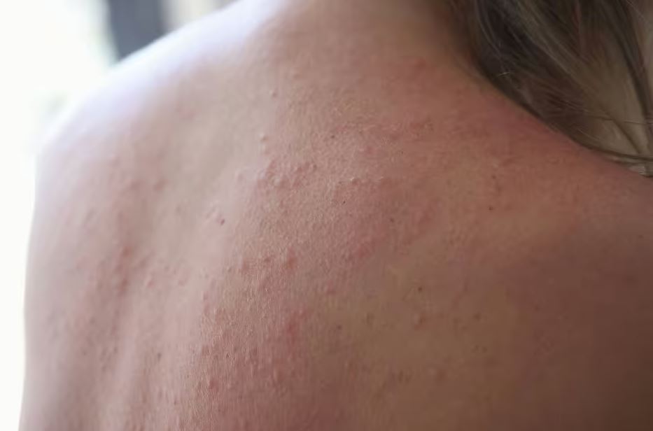 Hà Nội nóng nhất cả nước: Nếu thấy dấu hiệu này trên da, hãy gọi cấp cứu ngay- Ảnh 2.