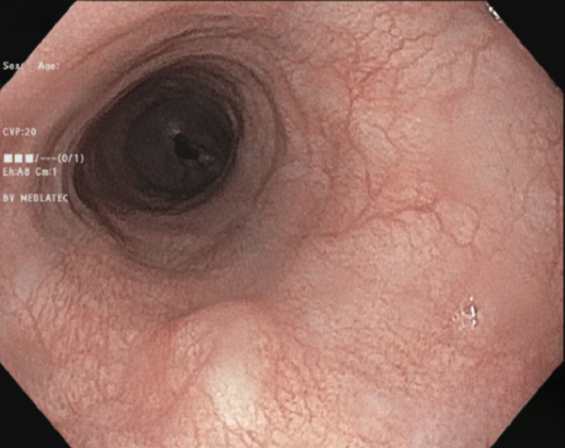 Phát hiện khối u ở thực quản nhờ... uống bia- Ảnh 1.