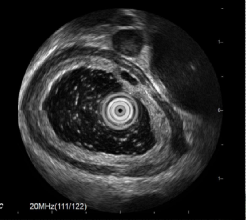 Phát hiện khối u ở thực quản nhờ... uống bia- Ảnh 2.