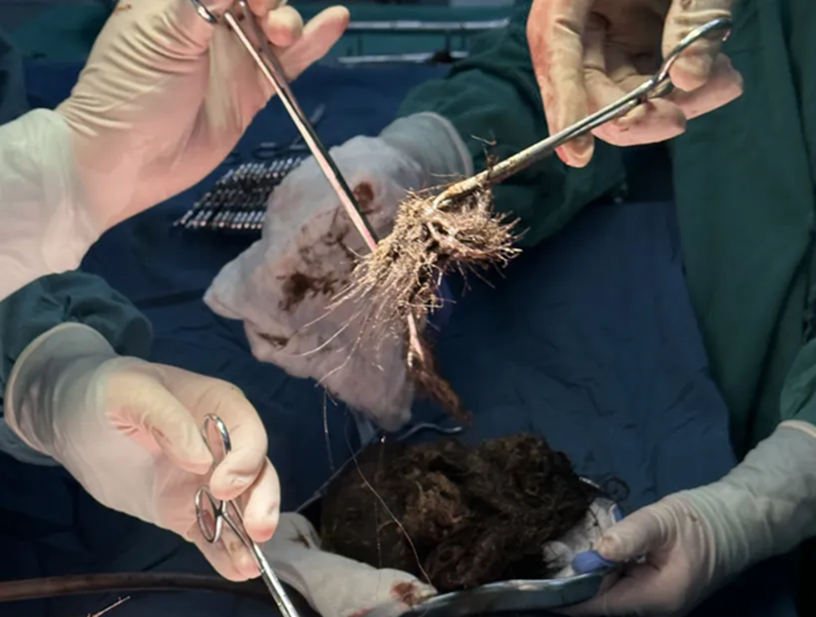 Thiếu nữ 15 tuổi nặng 35kg nhưng có tới "4kg là tóc" trong dạ dày - Ảnh 1.