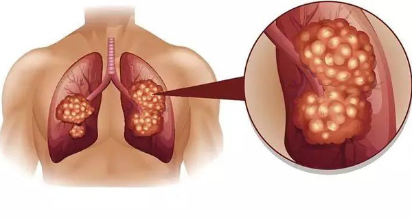Tại sao ung thư phổi lại “nhắm” vào những người không hút thuốc? Có 1 thứ trong bếp là "thủ phạm giấu mặt" nhưng ít ai biết- Ảnh 1.