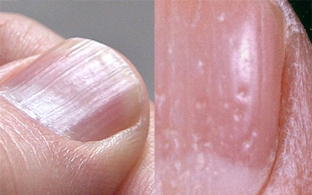 5 dấu hiệu xấu xí trên bàn tay cảnh báo thận của bạn đang kêu cứu!- Ảnh 2. 5 dấu hiệu xấu xí trên bàn tay cảnh báo thận của bạn đang kêu cứu!- Ảnh 2.