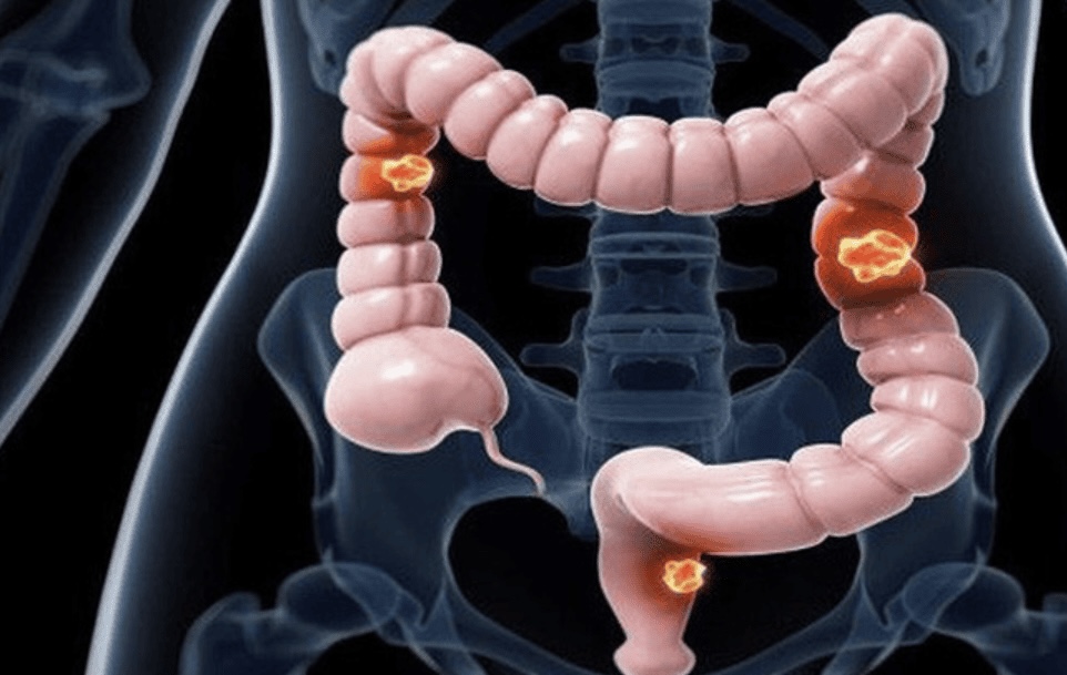 Nam thanh niên 25 tuổi bị đau bụng, tưởng rối loạn tiêu hoá: Kiểm tra phát hiện ung thư trực tràng giai đoạn muộn - những TÍN HIỆU bị BỎ QUÊN - Ảnh 1.