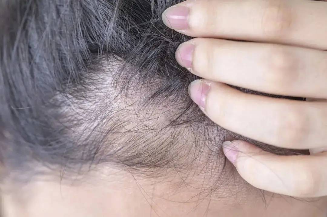 Tóc rụng lả tả chưa chắc là do thiếu chất, 4 thói quen vô tình này khiến tóc của bạn rụng nhiều hơn, điều thứ 3 lắm người mắc nhất- Ảnh 3.