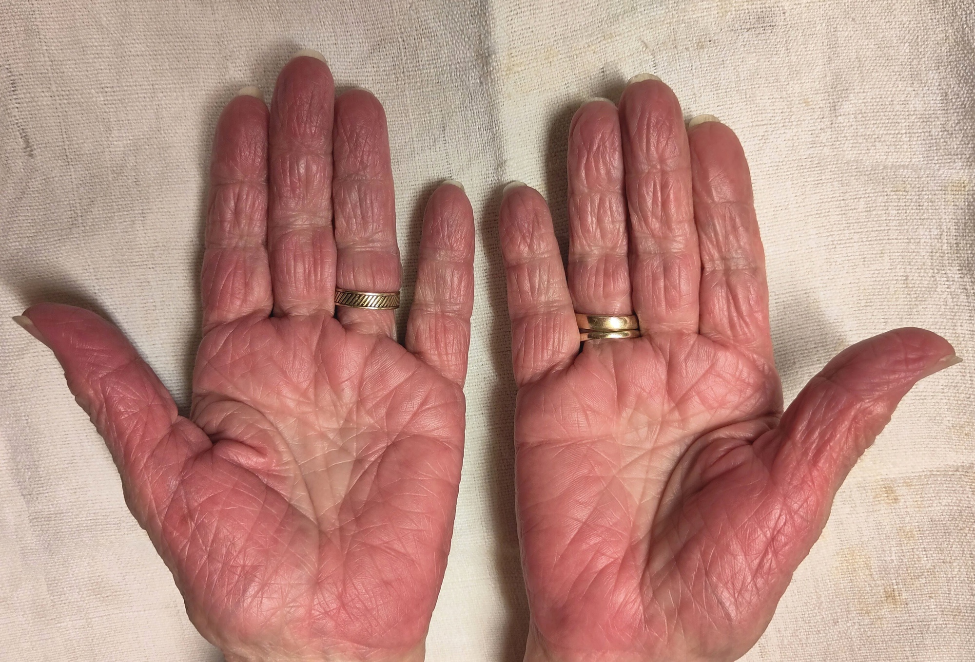 Những người có 5 bất thường này ở bàn tay khó tránh khỏi bệnh gan, có khi ung thư mà không biết!- Ảnh 1.