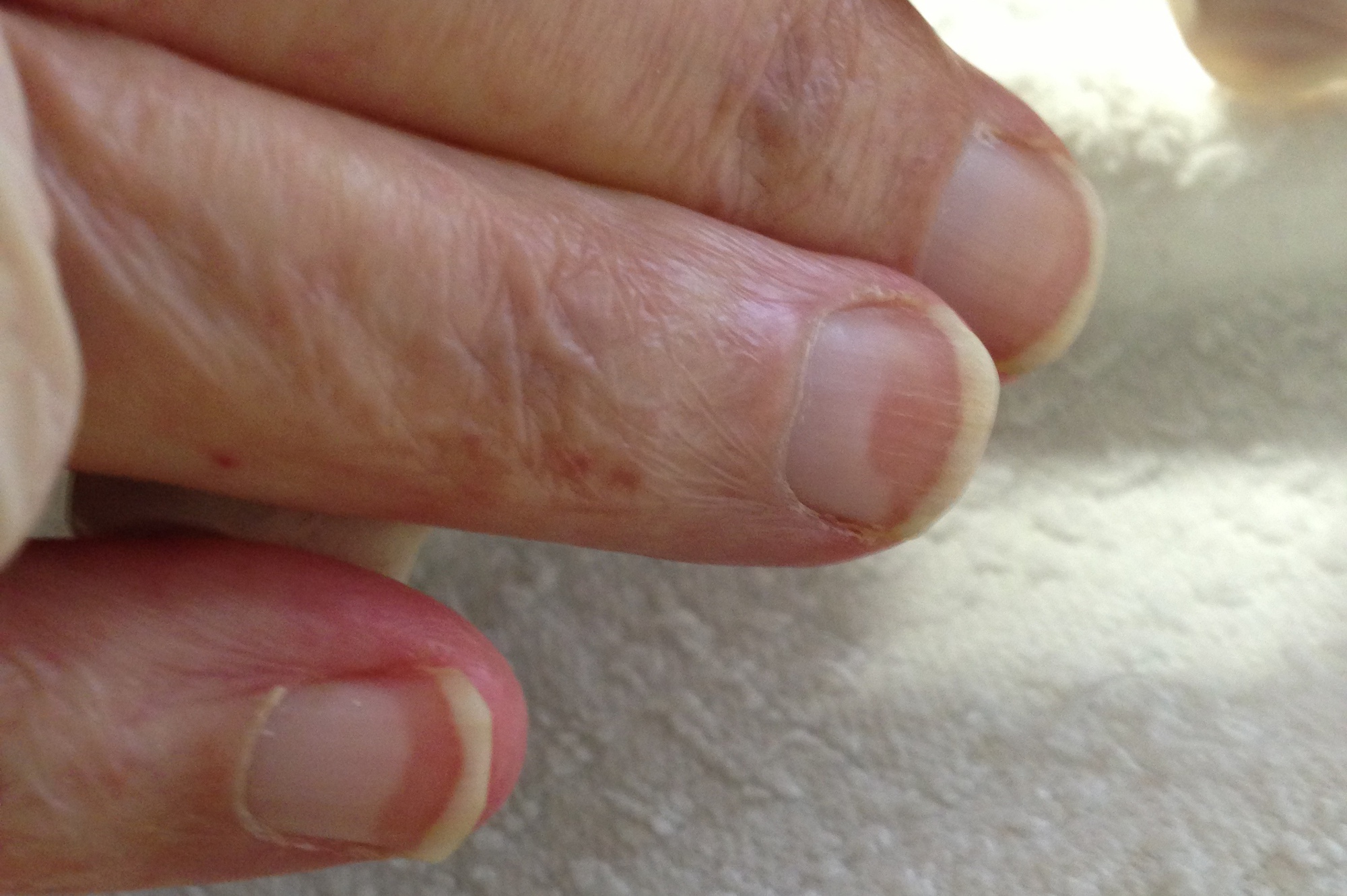 Những người có 5 bất thường này ở bàn tay khó tránh khỏi bệnh gan, có khi ung thư mà không biết!- Ảnh 3.