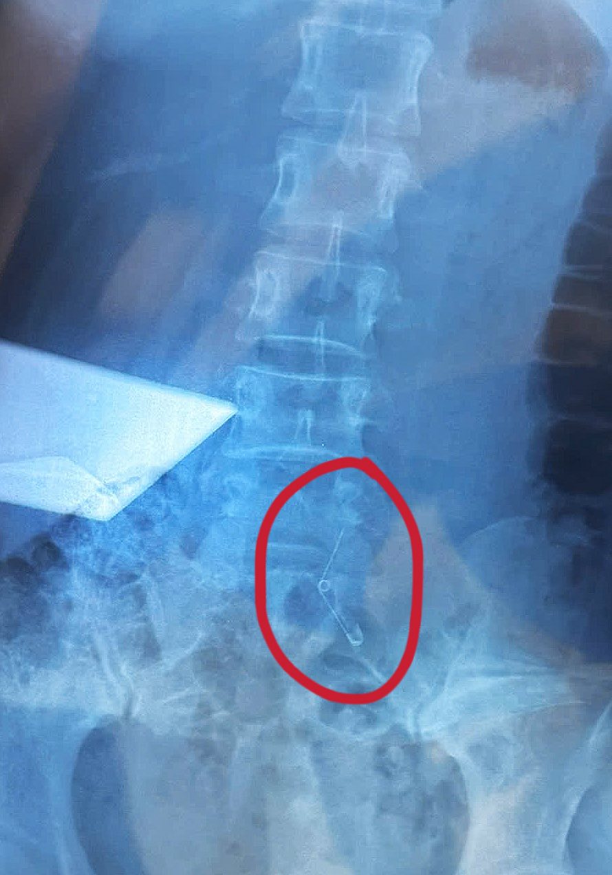 Đi ăn ốc, cô gái nuốt cả chiếc kim băng đang mở vào bụng, phải mổ cấp cứu 6 tiếng, tốn 70 triệu- Ảnh 2. Đi ăn ốc, cô gái nuốt cả chiếc kim băng đang mở vào bụng, phải mổ cấp cứu 6 tiếng, tốn 70 triệu- Ảnh 2.