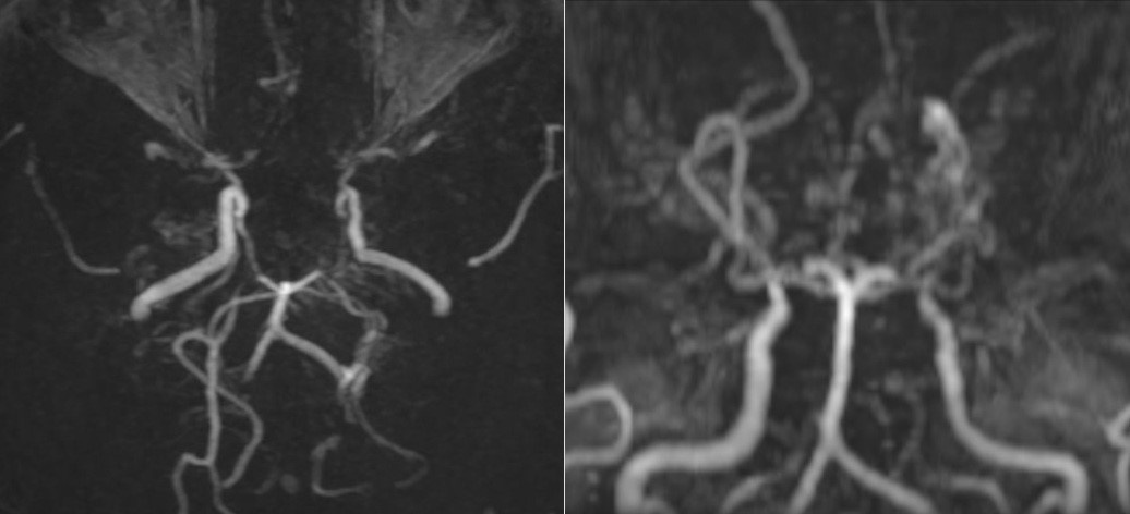 Hình ảnh MRI khiến bác sĩ bất ngờ: Mạch máu não bệnh nhân mờ như "khói thuốc"- Ảnh 1. Hình ảnh MRI khiến bác sĩ bất ngờ: Mạch máu não bệnh nhân mờ như "khói thuốc"- Ảnh 1.