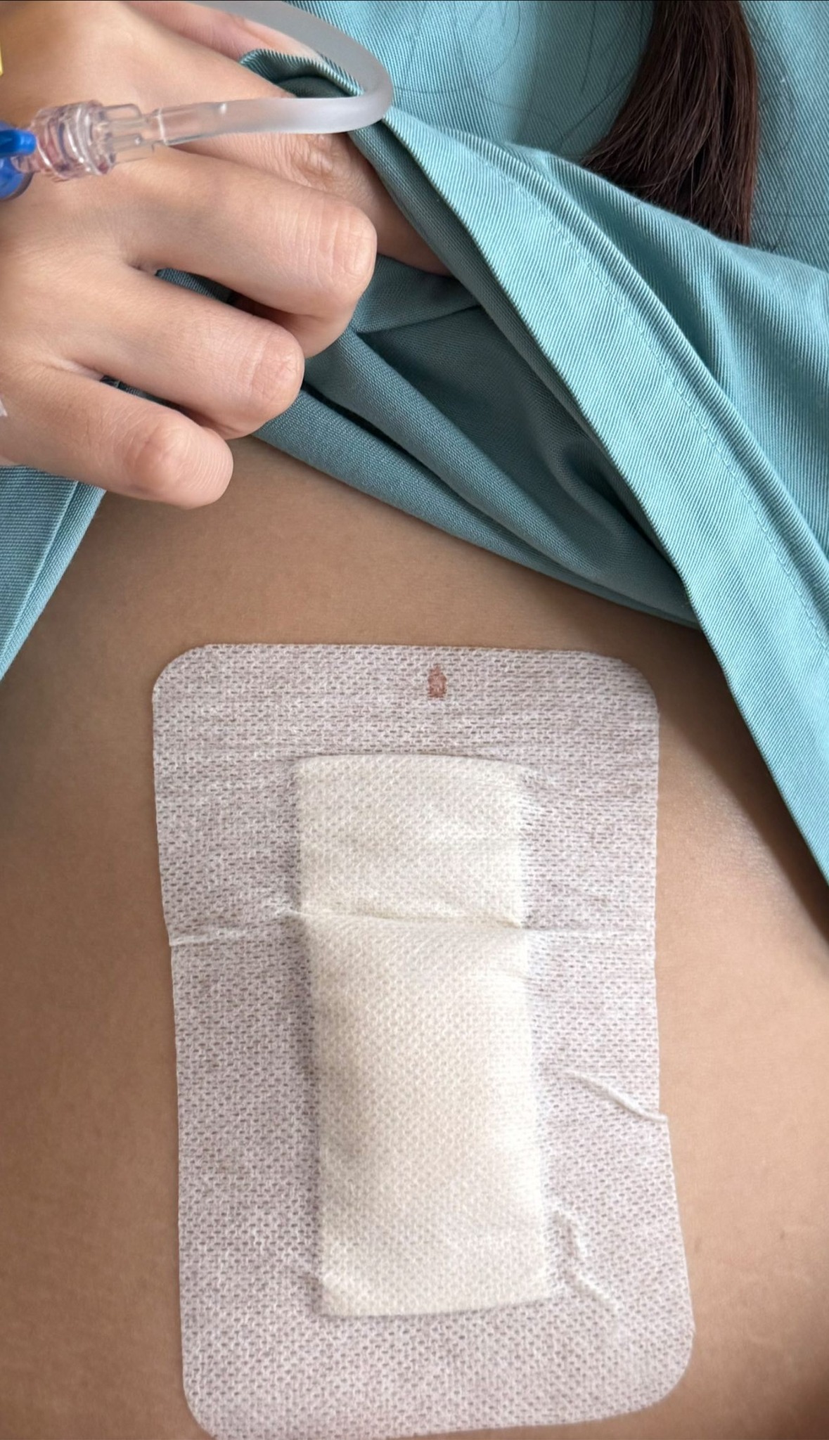 Đi ăn ốc, cô gái nuốt cả chiếc kim băng đang mở vào bụng, phải mổ cấp cứu 6 tiếng, tốn 70 triệu- Ảnh 3. Đi ăn ốc, cô gái nuốt cả chiếc kim băng đang mở vào bụng, phải mổ cấp cứu 6 tiếng, tốn 70 triệu- Ảnh 3.