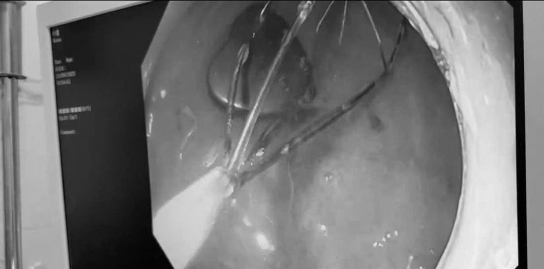 Khám cho bé trai 6 tuổi, bác sĩ sốc nặng khi phát hiện thứ "đáng sợ" trong dạ dày - Ảnh 1.