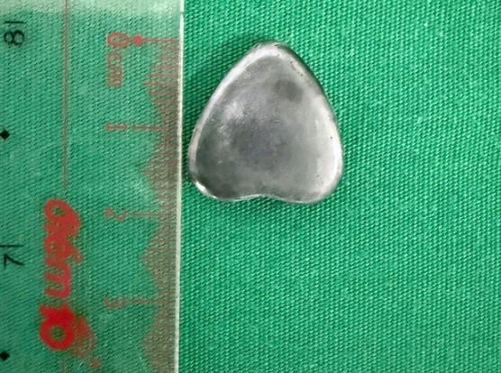 Khám cho bé trai 6 tuổi, bác sĩ sốc nặng khi phát hiện thứ "đáng sợ" trong dạ dày - Ảnh 2.