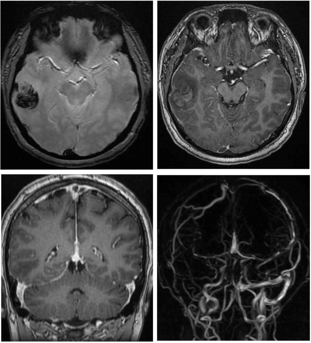 Bác sĩ bệnh viện 115 cảnh báo: Hút shisha có thể gây đột quỵ và huyết khối- Ảnh 2.