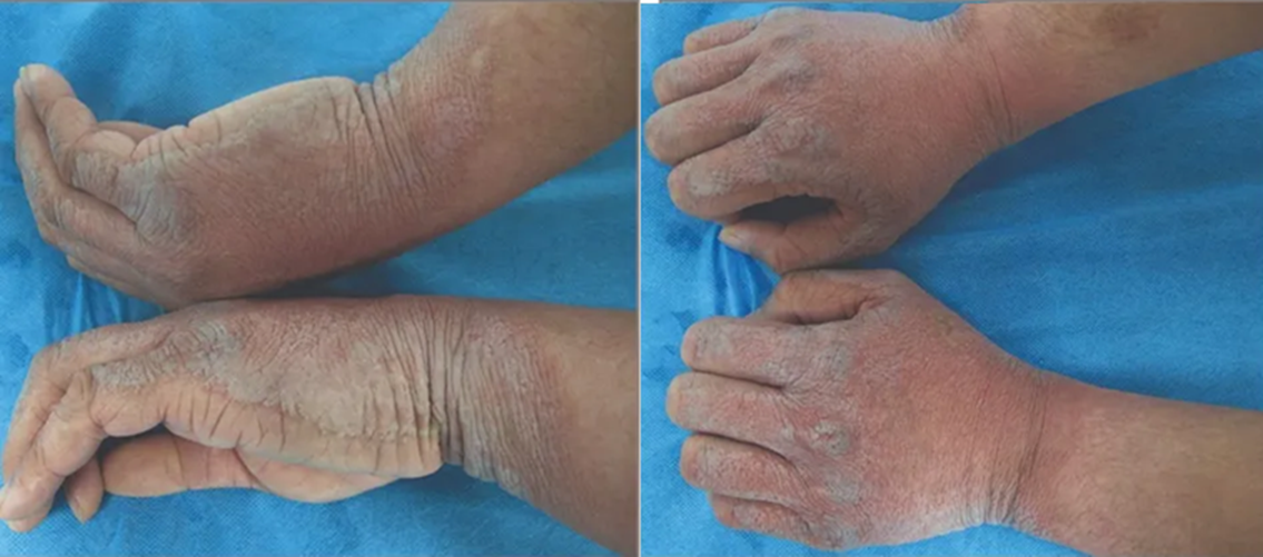 Ca bệnh hiếm gặp khiến bàn tay “lên vảy” mỗi khi rửa nước: bác sĩ cũng lúng túng khi chẩn đoán- Ảnh 1.