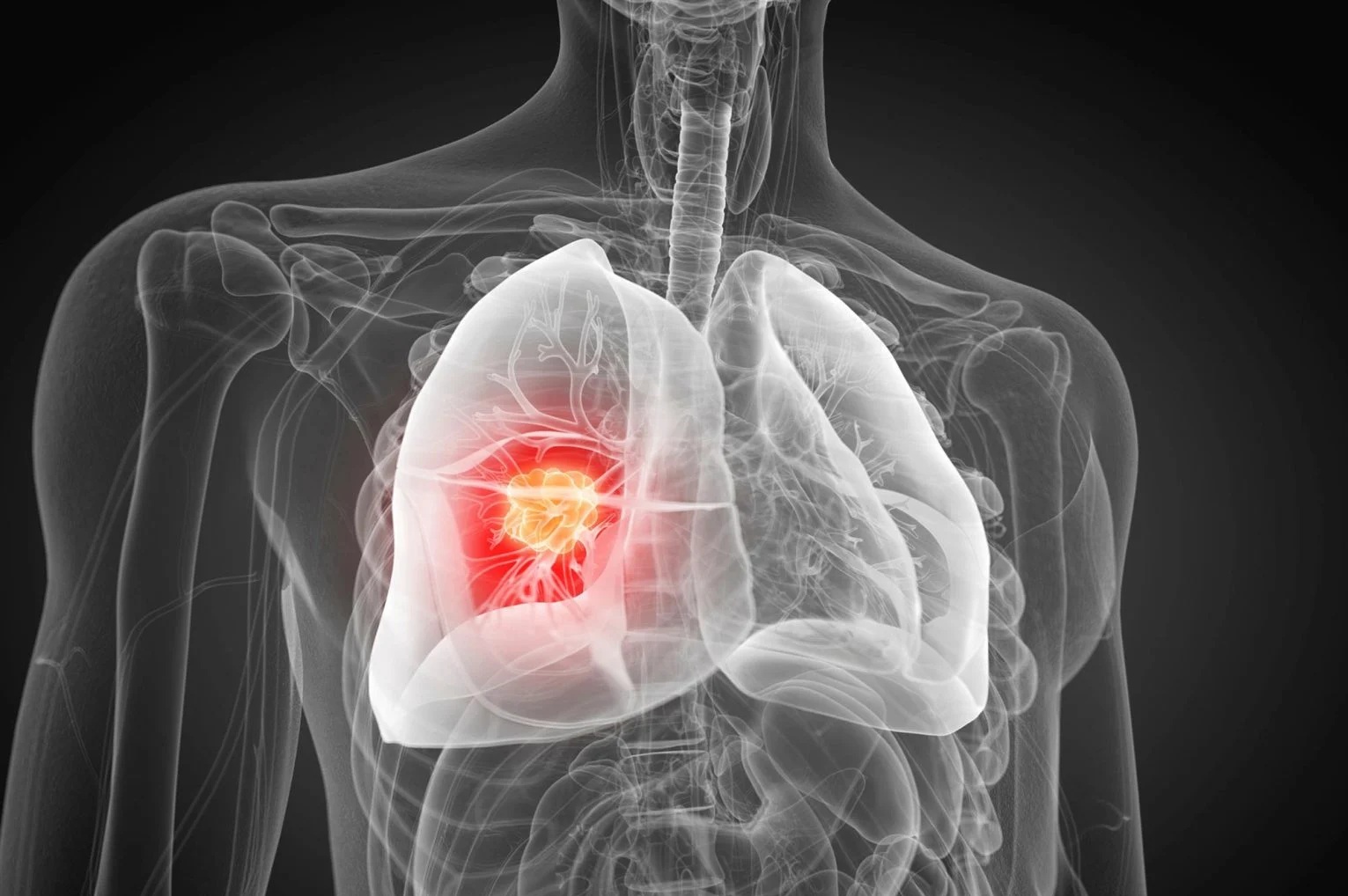 Phát hiện nguyên nhân gây ung thư phổi chưa từng biết - Ảnh 1.