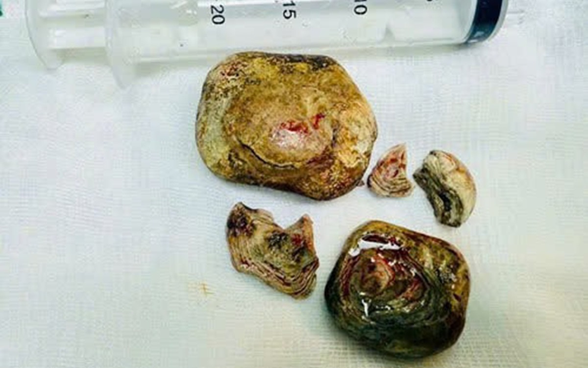 Người đàn ông 37 tuổi tử vong sau khi ăn món "vạn người mê" giữa đám đông - Ảnh 2.