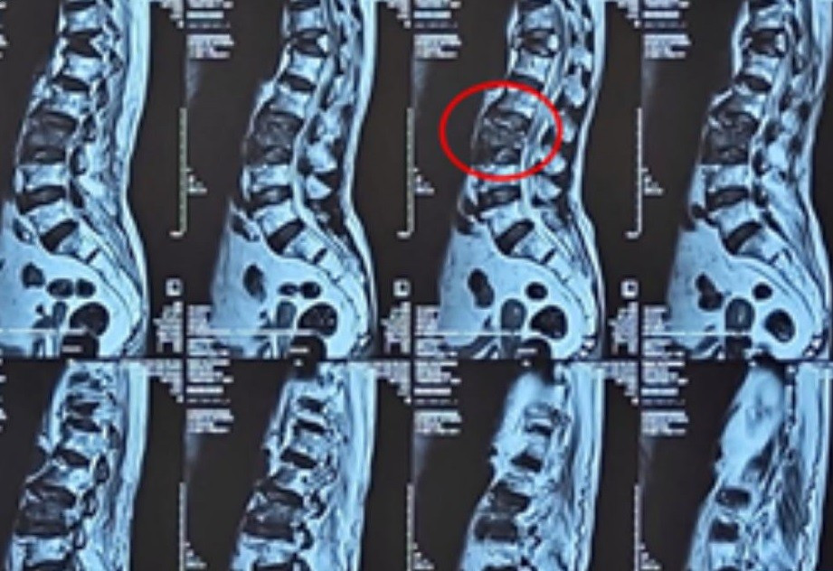 Bơm xi măng vào đốt sống giúp cụ bà 100 tuổi thoát khỏi đau đớn - Ảnh 1.