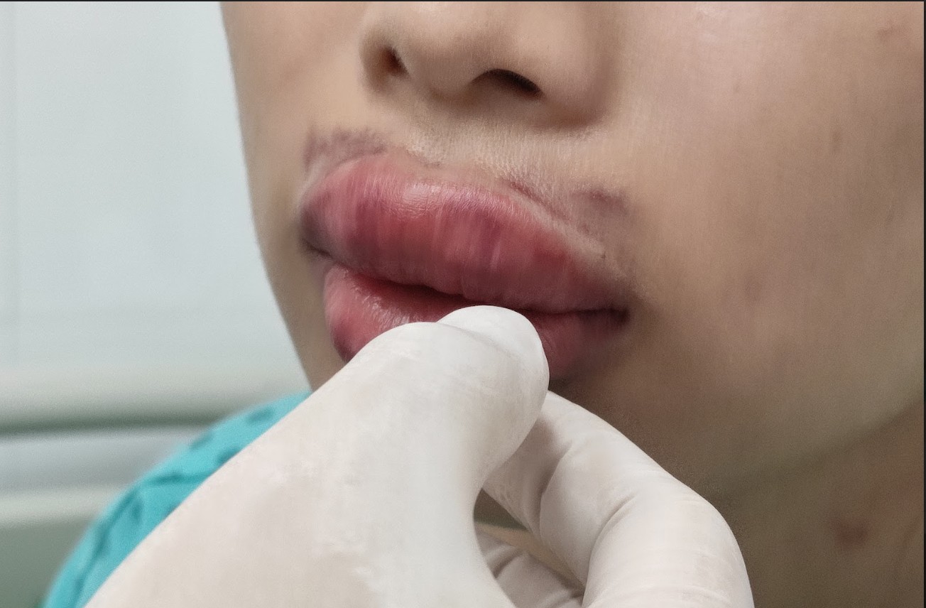 Làm đẹp cấp tốc: Cảnh báo họai tử mũi và biến dạng mặt vì tiêm filler trôi nổi - Ảnh 2.