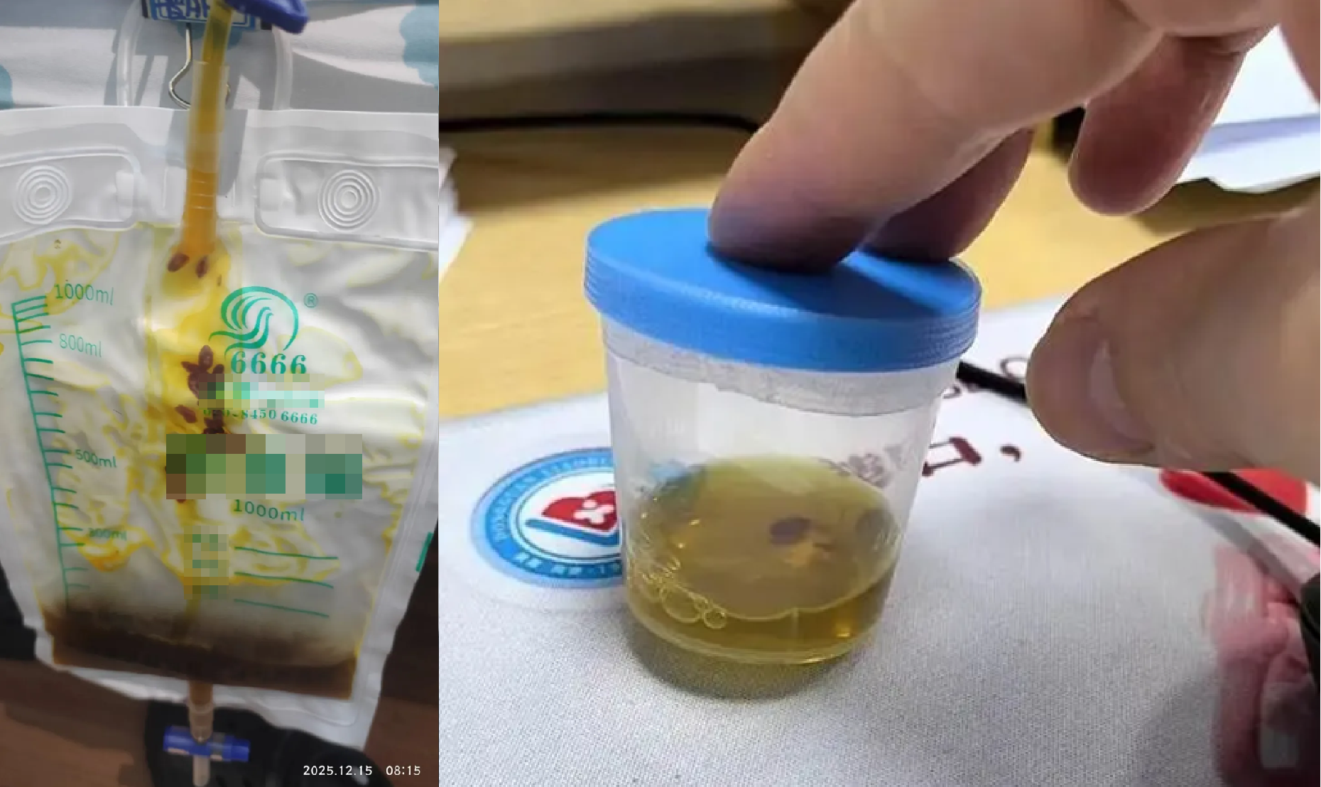 Bác sĩ phát hiện sán lá gan trong ống mật của người đàn ông 40 tuổi sau cơn đau bụng - Ảnh 3.