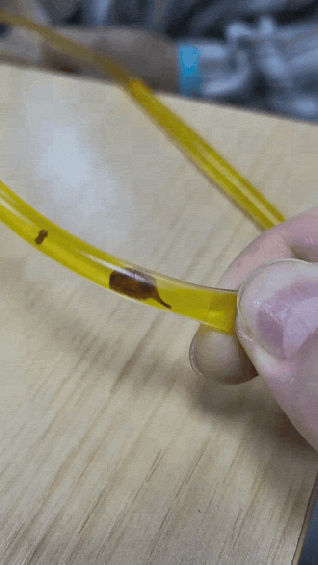 Bác sĩ phát hiện sán lá gan trong ống mật của người đàn ông 40 tuổi sau cơn đau bụng - Ảnh 2.