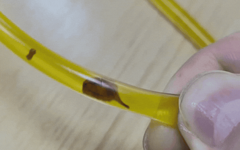 Bác sĩ phát hiện sán lá gan trong ống mật của người đàn ông 40 tuổi sau cơn đau bụng - Ảnh 1.