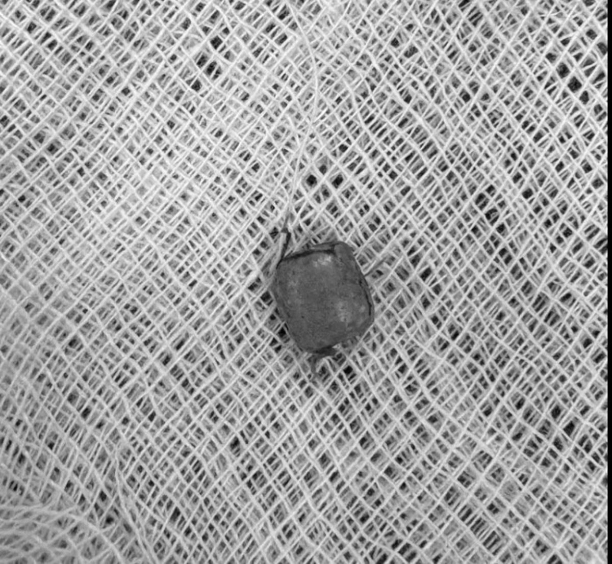 Bé 10 tuổi ù tai kéo dài: Nguy cơ từ dị vật tai mũi họng cần lưu ý - Ảnh 1. Bé 10 tuổi ù tai kéo dài: Nguy cơ từ dị vật tai mũi họng cần lưu ý - Ảnh 1.