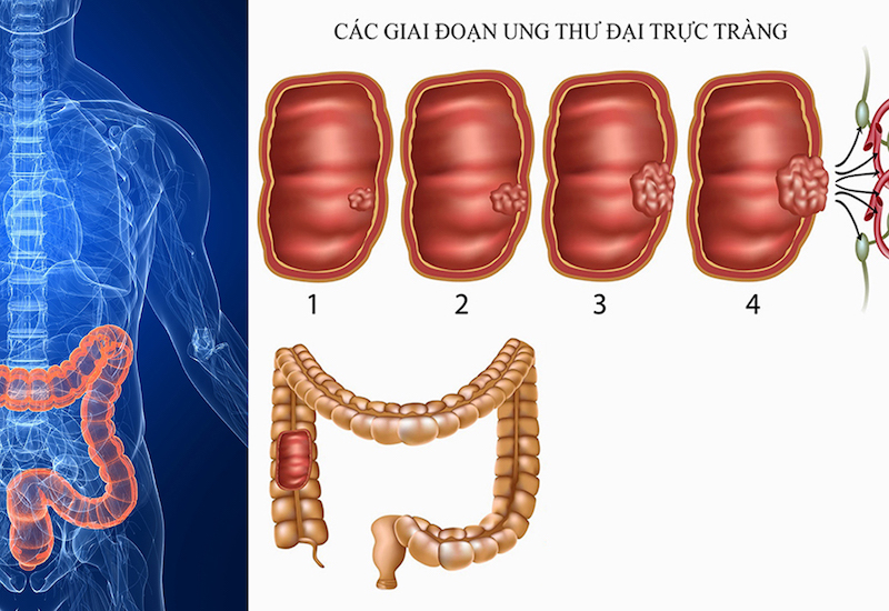 Phát hiện ung thư sớm và 8 dấu hiệu ung thư đại trực tràng dễ bị ngó lơ - Ảnh 2. Phát hiện ung thư sớm và 8 dấu hiệu ung thư đại trực tràng dễ bị ngó lơ - Ảnh 2.