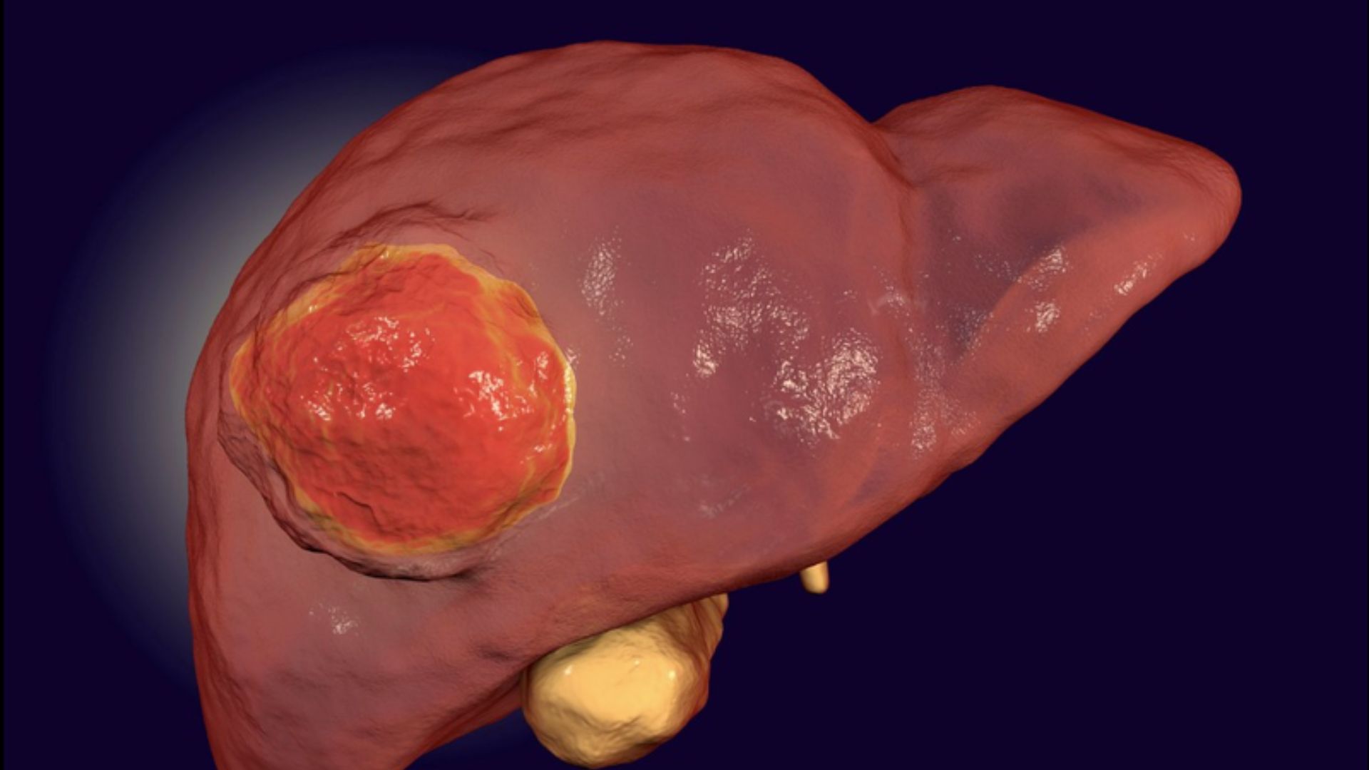 Bác sĩ chỉ ra 5 thói quen ăn uống nuôi ung thư gan của nhiều người trẻ