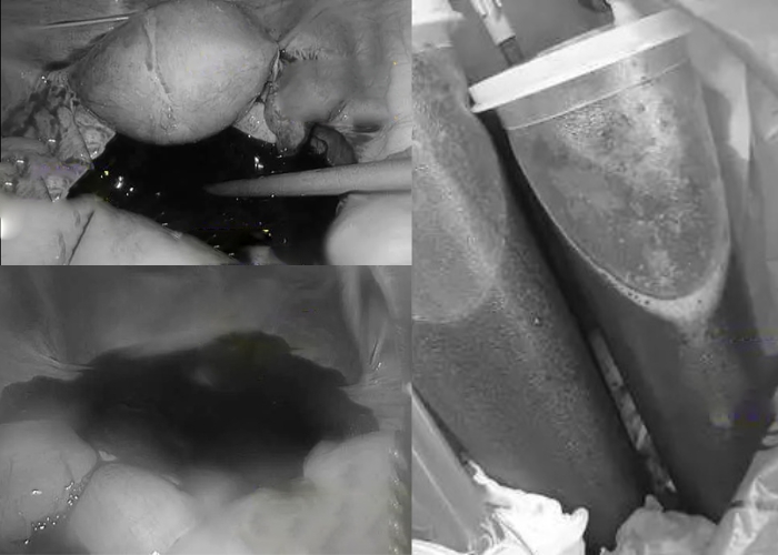 Cô gái trẻ chảy 1 , 5 lít máu vì quan hệ tình dục quá mạnh đêm valentine - Ảnh 2.