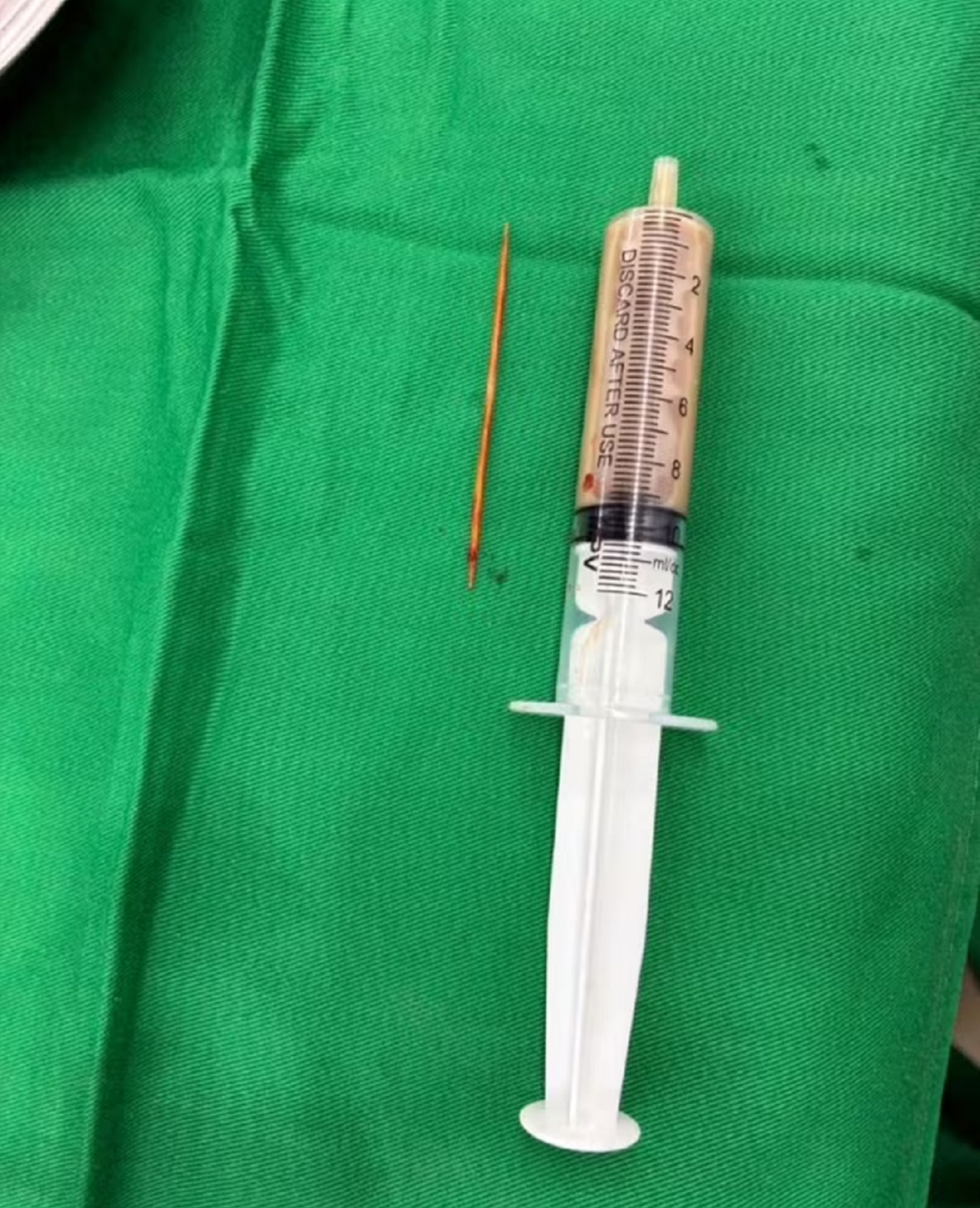 Người đàn ông bụng "cứng như đá", bác sĩ sốc khi phát hiện bí mật "đáng sợ" - Ảnh 1.